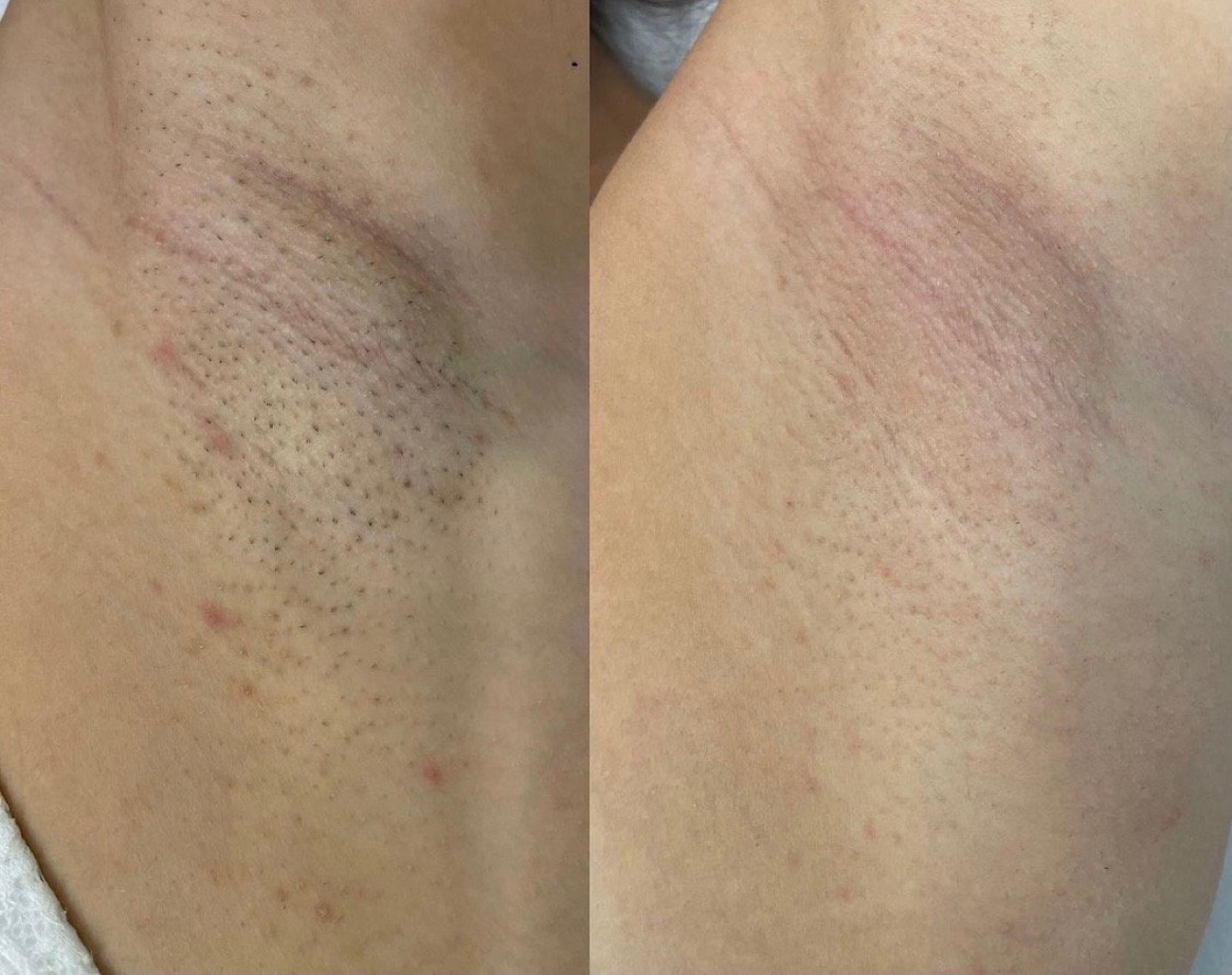 Avant et après six séances d'épilation laser aux aisselles