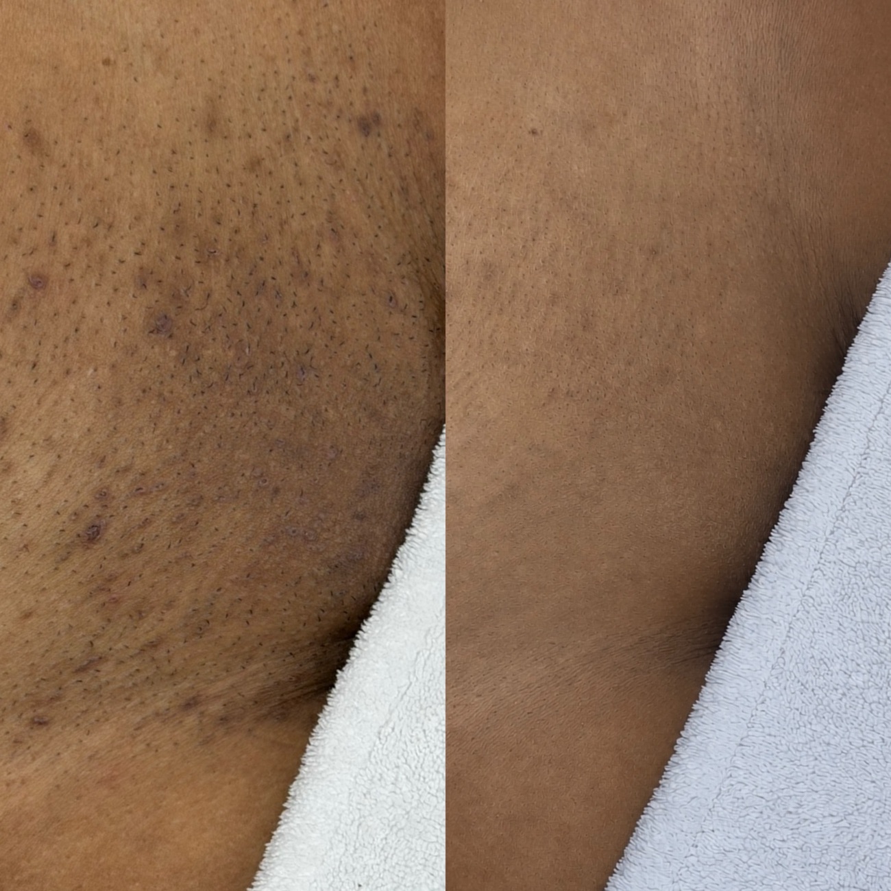 Avant et après six séances d'épilation laser aux aisselles sur une peau foncée