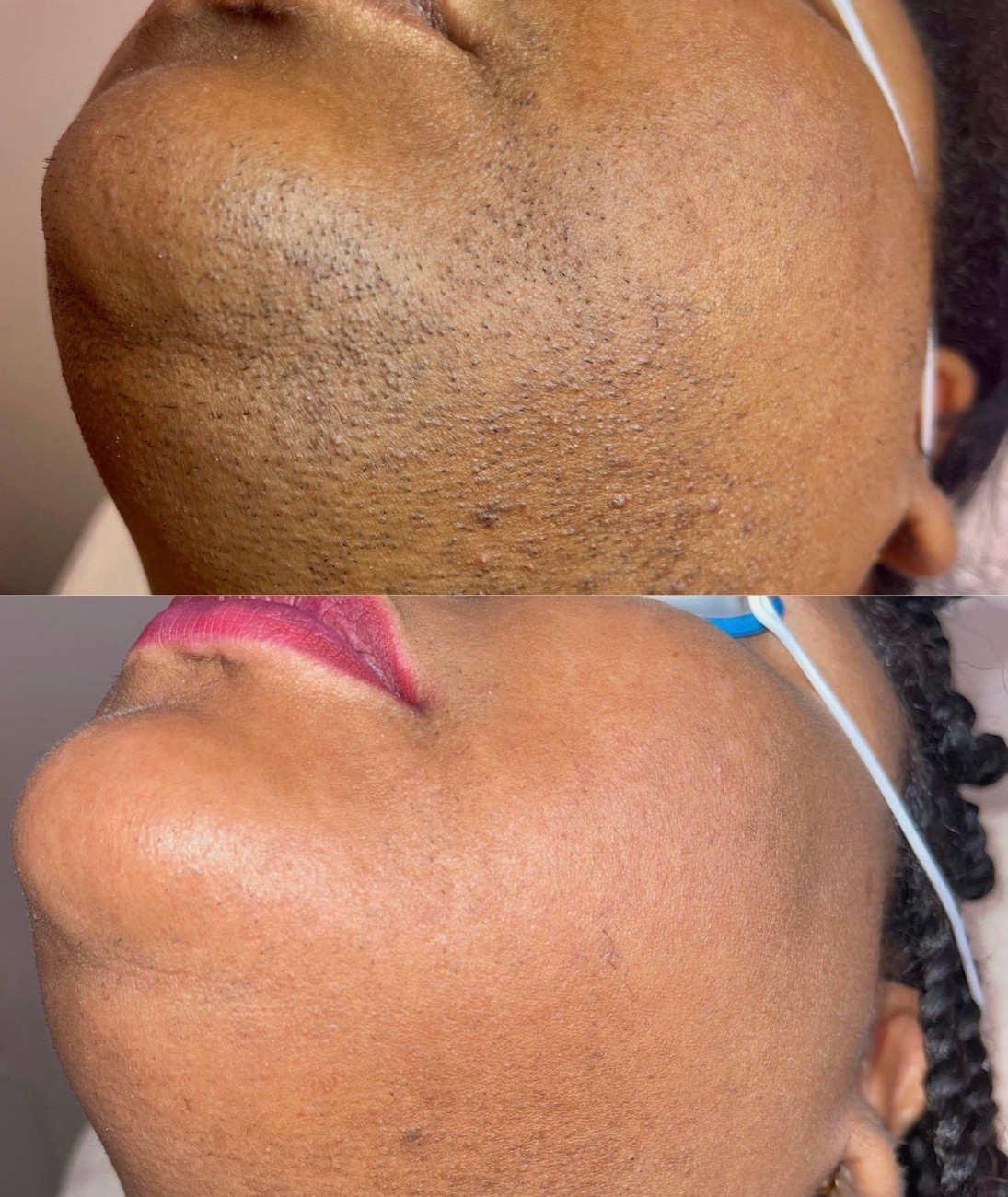 Avant et après huit séances d'épilation laser sur la barbe et le cou