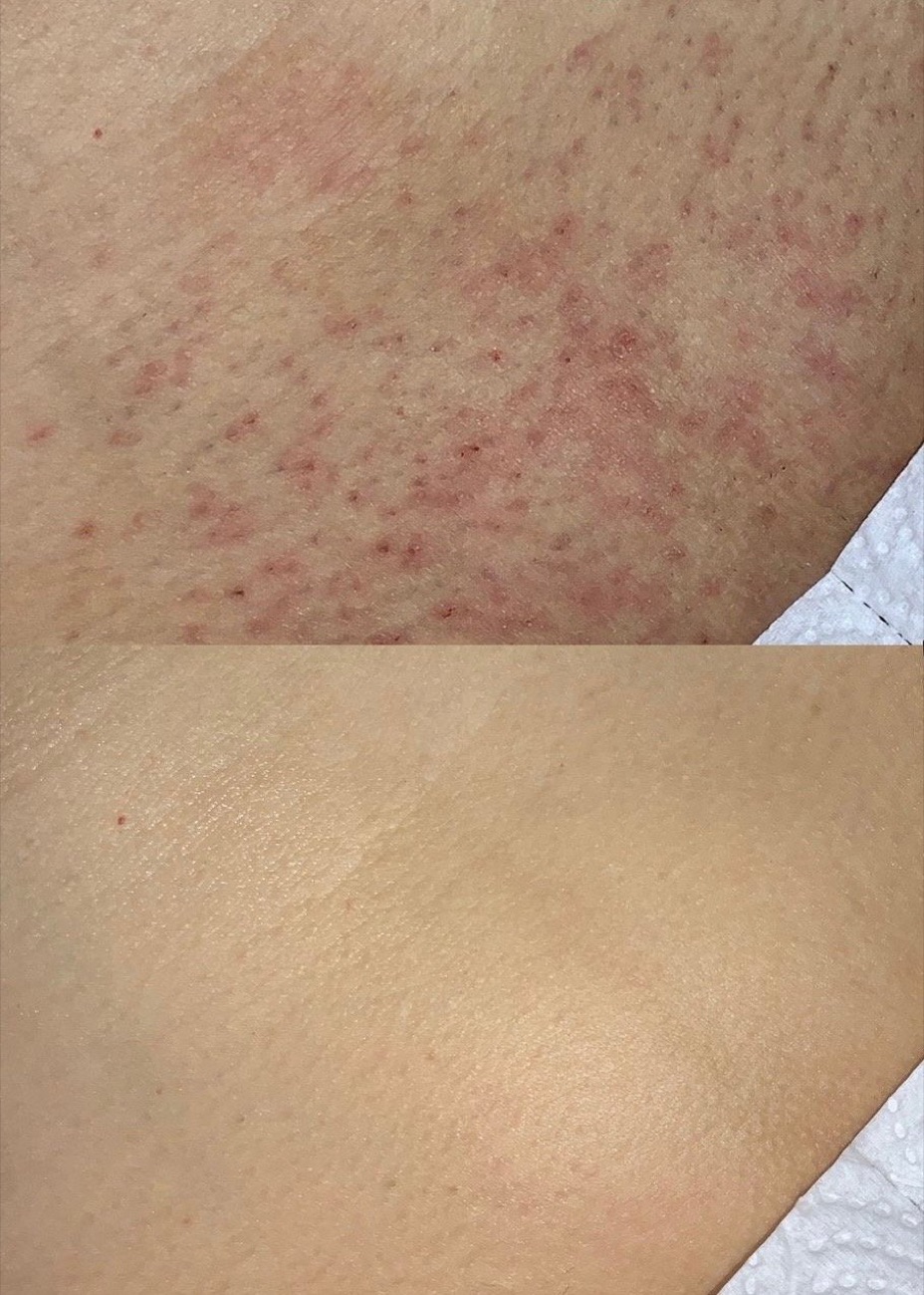 Avant et après cinq séances d'épilation laser sur les jambes